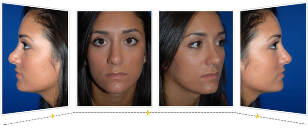 Illustration for article titled Nose Reshaping/Rhinoplasty